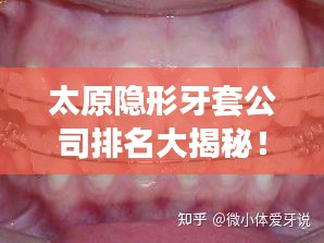 太原隱形牙套公司排名大揭秘！專業(yè)矯正牙齒，打造自信笑容！